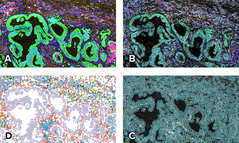 CosMx Spatial Molecular Imager (SMI) output on human lung cancer tissue. This platform images transcripts and proteins with single-cell resolution, enabling the creation of cell-type maps in situ.